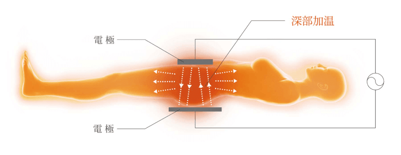 インディバ®の瀬術効果イメージ